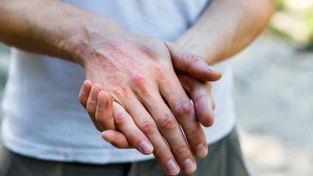 A person holds their left hand, which has visible redness and irritation on the back, possibly indicating a skin condition or allergic reaction.